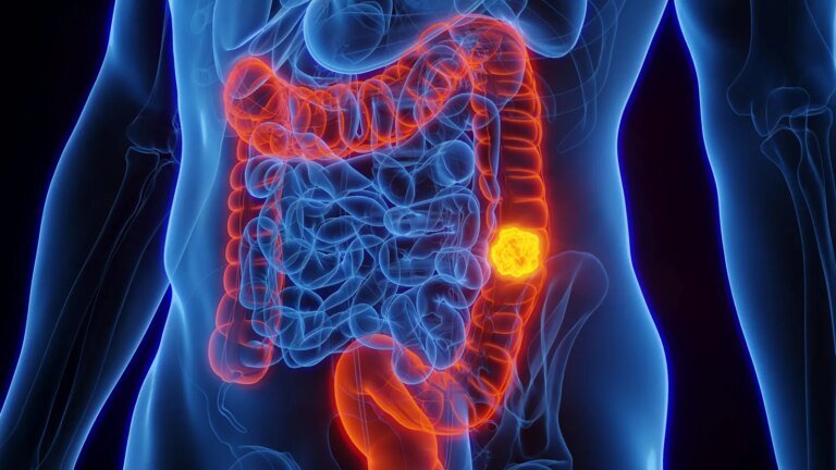 She Wasn’t Due For Her Colonoscopy. A Blood Test Found Cancer Anyway